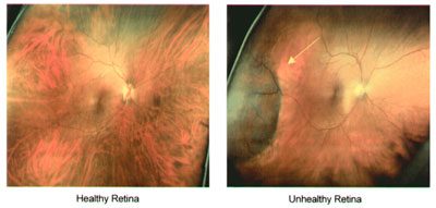 retina_images